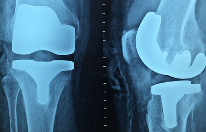 Glass bubble as potential adjunct with orthopaedic metal implants